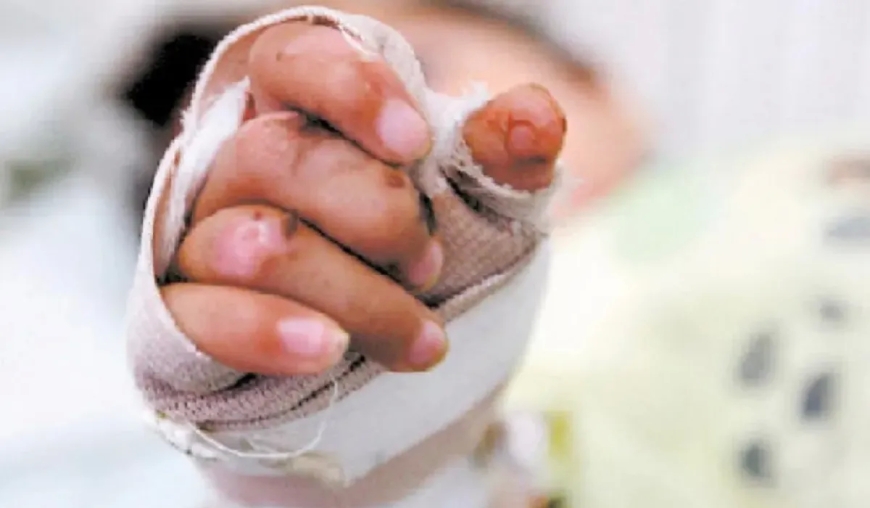 En Bolivia, le negaron la internación a una niña jujeña que sufrió quemaduras