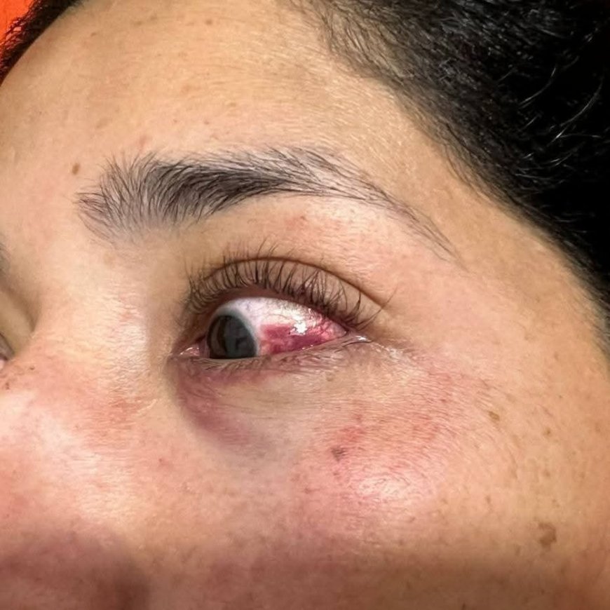 BOMBUCHA - Le lanzaron una bombucha en el ojo y sufrió daños